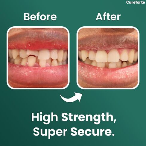 Cureforte Zinc Oxide Eugenol Dental Cement Kit – Professional Temporary Crown & Bridge Glue for Tooth Fillings | Self-Curing, Strong Bond, and Pulp-Soothing Formula | Easy-to-Use Dental Repair Kit in Kuwait