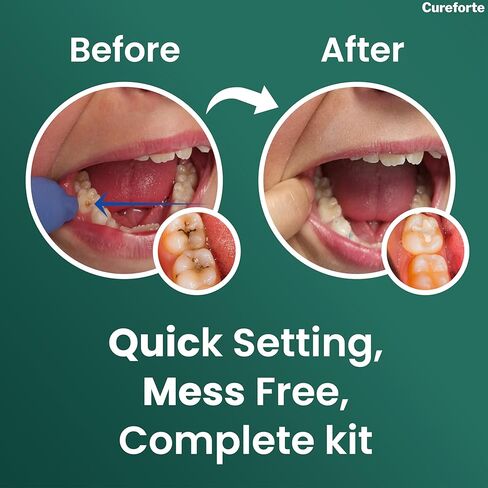 Cureforte Zinc Oxide Eugenol Dental Cement Kit – Professional Temporary Crown & Bridge Glue for Tooth Fillings | Self-Curing, Strong Bond, and Pulp-Soothing Formula | Easy-to-Use Dental Repair Kit in Kuwait