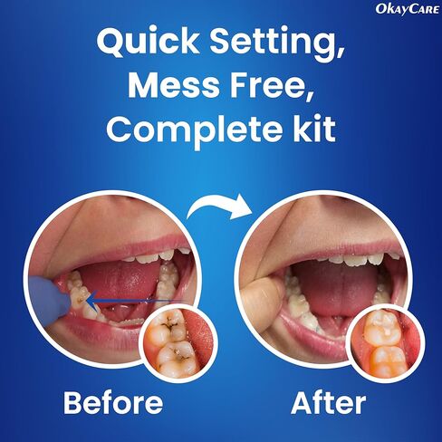 Zinc Oxide Eugenol Dental Cement Kit – Instant Tooth Repair, Cap, Crown & Bridge Filling | Ultra Strong & Pulp-Soothing Formula | Long Lasting - Easy Mix-and-Use Dental Adhesive for DIY, Home & Clinic in Kuwait