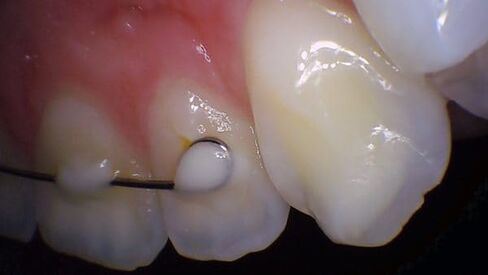 كاميرا PerfectCam HD داخل الفم بدقة 1280x720 مع برنامج Twain وزر الالتقاط مجانًا! توقف عن استخدام 640x480 مثل Prodent وDaryou وMoutwatch in Kuwait