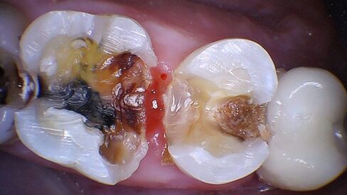 كاميرا PerfectCam HD داخل الفم بدقة 1280x720 مع برنامج Twain وزر الالتقاط مجانًا! توقف عن استخدام 640x480 مثل Prodent وDaryou وMoutwatch in Kuwait