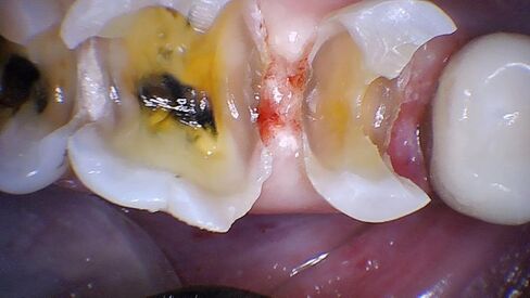 كاميرا PerfectCam HD داخل الفم بدقة 1280x720 مع برنامج Twain وزر الالتقاط مجانًا! توقف عن استخدام 640x480 مثل Prodent وDaryou وMoutwatch in Kuwait