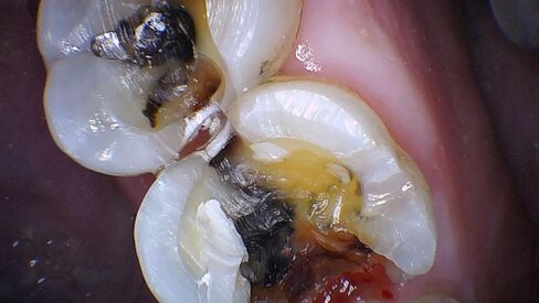 كاميرا PerfectCam HD داخل الفم بدقة 1280x720 مع برنامج Twain وزر الالتقاط مجانًا! توقف عن استخدام 640x480 مثل Prodent وDaryou وMoutwatch in Kuwait