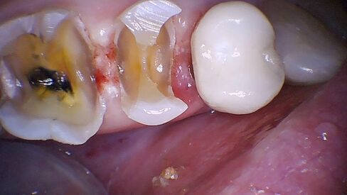 كاميرا PerfectCam HD داخل الفم بدقة 1280x720 مع برنامج Twain وزر الالتقاط مجانًا! توقف عن استخدام 640x480 مثل Prodent وDaryou وMoutwatch in Kuwait