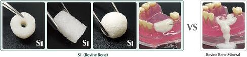 MedPark S1 Bovine Xenograft، 1 جرام، عظم لزج in Saudi Arabia
