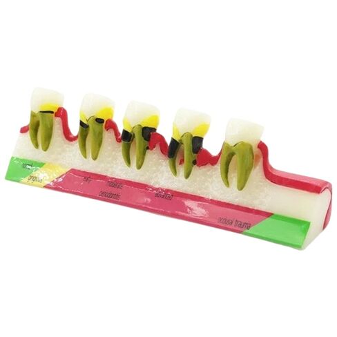 UKYCEORA Teeth Model,Dental Teeth Model,Dental Implant Model,Removable Analysis Crown Bridge Demonstration, Dental Model for Class Education.(periodontal) in Saudi Arabia