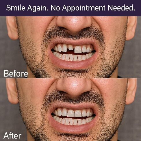 DenVana Dental Cement Kit – Zinc Oxide Eugenol Temporary Filling & Crown Repair | Tooth Repair Kit for Broken or Loose Caps, Bridges & Dentures | Strong Adhesive Glue | Instant Smile Fix | US Brand in Kuwait