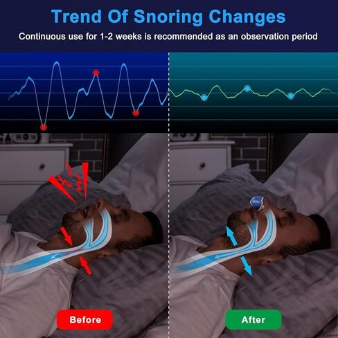 أجهزة شخير مضادة - محلول شخير - ميني مضاد للشخير المساعدات للنوم - سرعة متغيرة متغيرة صغيرة مضادة للشخير - موسع أنف دوامة مزدوجة - 2 ب - 2 ب in Kuwait