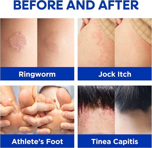 كريم هيرمون القوي المضاد للفطريات - علاج فعال للقوباء الحلقية العنيدة، وحكة اللعب، والأكزيما، والسعفة المبرقشة، وقدم الرياضي - للبالغين والأطفال - 100 مل (كريم + 2 بار-لافندر) in Kuwait