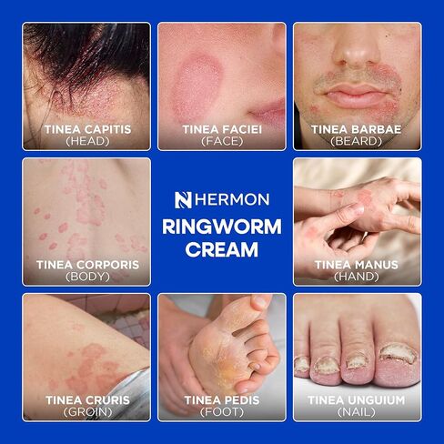 كريم هيرمون القوي المضاد للفطريات - علاج فعال للقوباء الحلقية العنيدة، وحكة اللعب، والأكزيما، والسعفة المبرقشة، وقدم الرياضي - للبالغين والأطفال - 100 مل (كريم + 2 بار-لافندر) in Kuwait