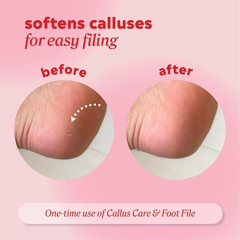 مزيل مسامير القدم الاحترافي من أونيكس - 3.5 أونصة، تركيبة قوية غير معطرة - جل قوي للغاية، يزيل مسامير القدم غير المرغوب فيها في 3-5 دقائق، مزيل مسامير القدم المرطب والتنعيم، 3 عبوات in Kuwait