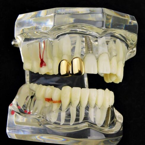 Double Tooth Grillz 14k Gold Plated Upper Top Right Side Canine Two Teeth Grills in Kuwait