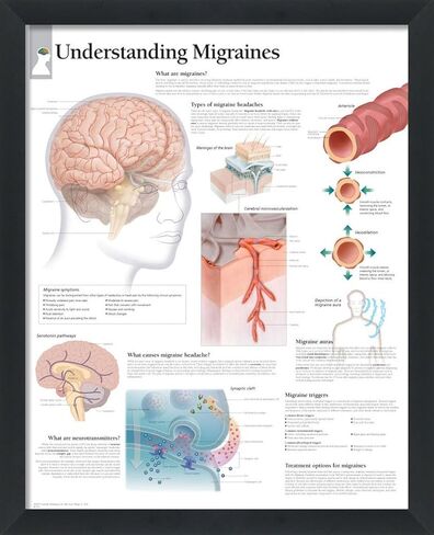 Set of 2 Framed Medical Posters Understanding The Head and Neck and Understanding Migraines 22"x28" Wall Diagrams Educational Informational Doctors Office Charts in Kuwait