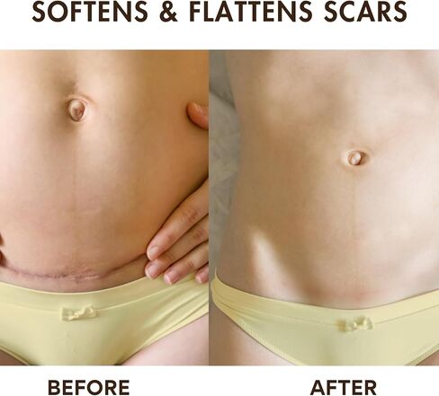 C Section Scar Silicone Strips - 6 Pack, Extra Long Reusable & Medical Grade Silicone Sheets for C Section Recovery in Saudi Arabia