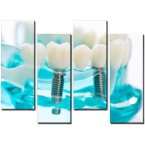 Wocatton dental model on white background dentals and pictures Wall Art Background Decor Pictures Print On Canvas Art Stretched and Framed Perfect Home Decoration