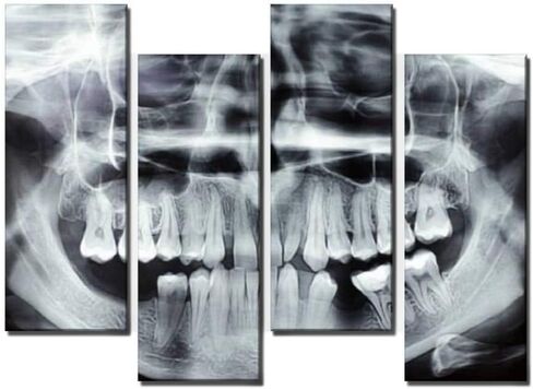 Wocatton dental model on white background dentals and pictures Wall Art Background Decor Pictures Print On Canvas Art Stretched and Framed Perfect Home Decoration in Saudi Arabia