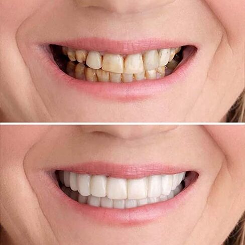 2 Pairs Top and Bottom, Adjustable Temporary Cosmetic, Natural Comfortable for Beautiful Smile Instant Confidence(White) in Saudi Arabia