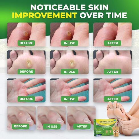 Corn Remover Pads for Feet Toes: 30-Pack Salicylic Acid Extra Strength Treatment - Fast Effective Medicated Bandages for Kids Adults Seniors Teens Athletes Runners Hikers Workers Men Women in Kuwait