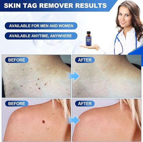 Fast-Acting Skin Tag Remover for Body and Neck - Natural, Mild Salicylic Acid Formula, Use a Brush applicator Skin tag Remover Precisely and painlessly and Quickly.Safe for Sensitive skin30ML in Kuwait