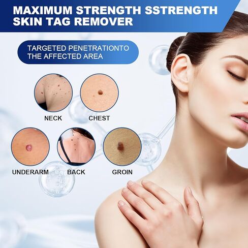 Fast-Acting Skin Tag Remover for Body and Neck - Natural, Mild Salicylic Acid Formula, Use a Brush applicator Skin tag Remover Precisely and painlessly and Quickly.Safe for Sensitive skin30ML in Kuwait