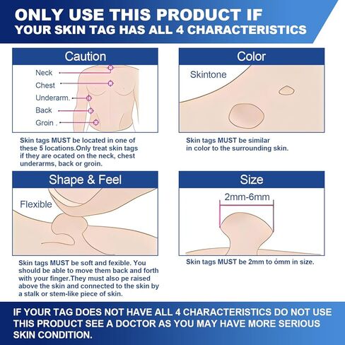 Fast-Acting Skin Tag Remover for Body and Neck - Natural, Mild Salicylic Acid Formula, Use a Brush applicator Skin tag Remover Precisely and painlessly and Quickly.Safe for Sensitive skin30ML in Kuwait