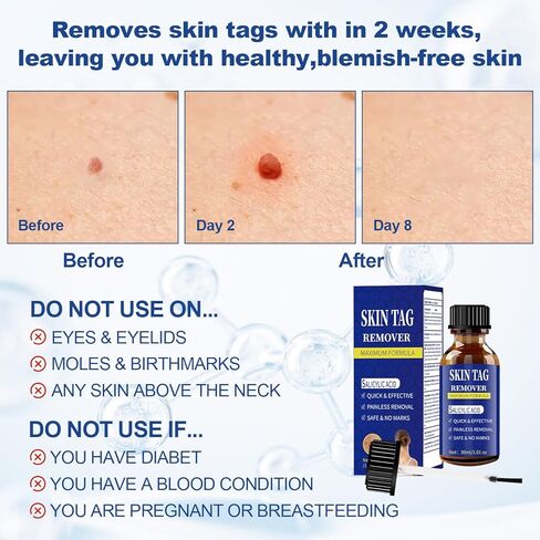 Fast-Acting Skin Tag Remover for Body and Neck - Natural, Mild Salicylic Acid Formula, Use a Brush applicator Skin tag Remover Precisely and painlessly and Quickly.Safe for Sensitive skin30ML in Kuwait