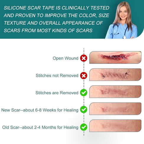 Silicone Scar Sheets (1.6"x 158" Roll-4M), Silicone Scar Tape for Scar Removal Treatment, Reusable Silicone Scar Strips for C-Section, Keloid, Burn, Acne, Surgical Scars in Kuwait