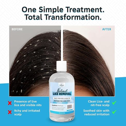 Safe Natural Lice Treatment for Kids & Adults w/ Lice Comb | Gentle, Non-Irritating Lice Shampoo That Kills Eggs and Lice on All Hair Types | Dimethicone Safely Suffocates | 8oz Treats 1-2 People in Kuwait