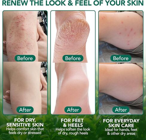 بلسم شجرة الشاي للتخفيف السريع من حكة الجلد - يخفف الانزعاج الناتج عن لدغات الحشرات والطفح الجلدي وجفاف الجلد وتهيج القدم - تركيبة طبيعية وخالية من العطور ولطيفة، آمنة للبشرة الحساسة وجميع الأعمار in Kuwait