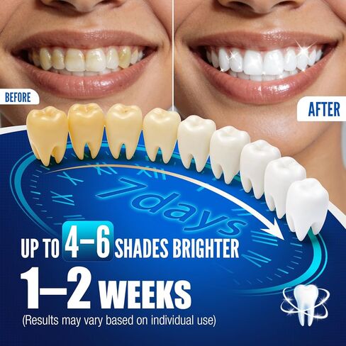 Teeth Whitening Pen Kit - 35% Carbamide Peroxide, Stain Removal, 4 Whitening Pens + 2 Remineralizing Pens, Enamel Repair, Anti-Cavity, Sensitive Teeth Care, 6 x 0.14 fl oz (Spearmint) in Kuwait