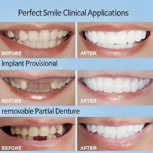 2 Pairs of Unisex Smile Supports,Natural Comfort, Adjustable Comfort, Create A Beautiful and Confident Smile (Unisex) in Kuwait