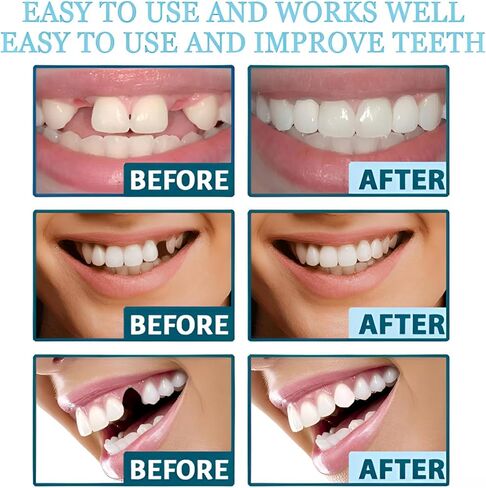 Veneers Teeth for Women, Tooth Replacement Kit, Nature and Comfortable in Kuwait
