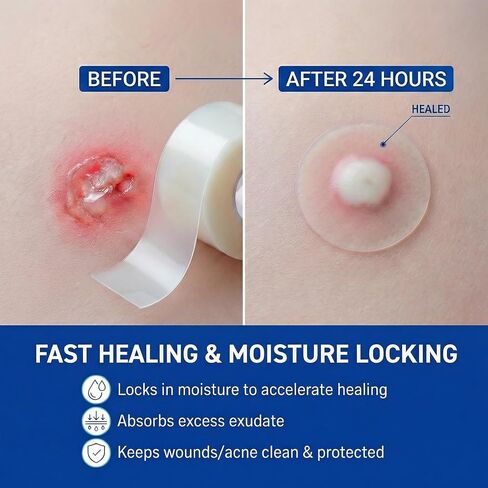 لفة غرواني مائي، ضمادات غرواني مائي للعناية بالجروح، 2 بوصة × 18 قدم، رقعة غرواني مائي مقطوعة حسب الحجم، ذاتية اللصق مرنة ومقاومة للماء للحروق والبثور والعناية بحب الشباب in Kuwait