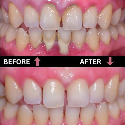 أداة مكشطة جير الأسنان من بروماكس - مزيل البلاك من الفولاذ المقاوم للصدأ لتنظيف الأسنان - أداة نظافة الفم قطعة واحدة in Kuwait