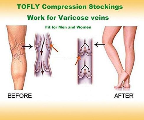 TOFLY® جوارب ضغط طبية متدرجة 30-40 مم زئبقي للرجال والنساء، جوارب ضغط عالية للركبة مفتوحة عند الأصابع، دعم قوي لاستعادة الدورة الدموية، جبائر الساق، الدوالي، الوذمة، التمريض in Kuwait