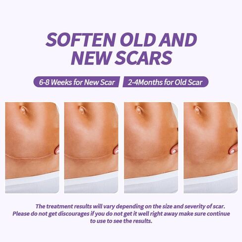 أوراق الندبات المصنوعة من السيليكون من الدرجة الطبية، (لفة الندبات 1.6 بوصة × 60 بوصة - 1.5 متر) - شرائط شريط إزالة الندبات القابلة لإعادة الاستخدام للعمليات الجراحية، القسم القيصري، شد البطن، إزالة نتوءات الجدرة (طبيعية) in Kuwait