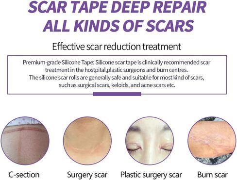 أوراق الندبات المصنوعة من السيليكون من الدرجة الطبية، (لفة الندبات 1.6 بوصة × 60 بوصة - 1.5 متر) - شرائط شريط إزالة الندبات القابلة لإعادة الاستخدام للعمليات الجراحية، القسم القيصري، شد البطن، إزالة نتوءات الجدرة (طبيعية) in Kuwait