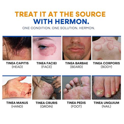 غسول الجسم لعلاج السعفة المضاد للفطريات - غسول مضاد للبكتيريا مع 1% تولنافتات وزيت شجرة الشاي للقوباء الحلقية وحكة اللعب والتينيا وحب الشباب في الظهر ورائحة القدم على الظهر والصدر والفخذ والقدمين للرجال والنساء 500 مل in Kuwait