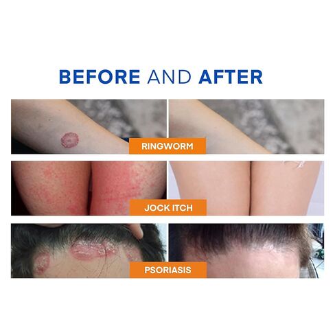 غسول الجسم لعلاج السعفة المضاد للفطريات - غسول مضاد للبكتيريا مع 1% تولنافتات وزيت شجرة الشاي للقوباء الحلقية وحكة اللعب والتينيا وحب الشباب في الظهر ورائحة القدم على الظهر والصدر والفخذ والقدمين للرجال والنساء 500 مل in Kuwait