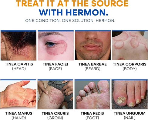 غسول الجسم لعلاج السعفة المضاد للفطريات - غسول مضاد للبكتيريا مع 1% تولنافتات وزيت شجرة الشاي للقوباء الحلقية وحكة اللعب والتينيا وحب الشباب في الظهر ورائحة القدم على الظهر والصدر والفخذ والقدمين للرجال والنساء 500 مل in Kuwait