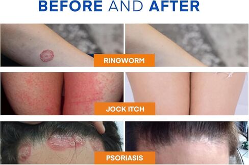 غسول الجسم لعلاج السعفة المضاد للفطريات - غسول مضاد للبكتيريا مع 1% تولنافتات وزيت شجرة الشاي للقوباء الحلقية وحكة اللعب والتينيا وحب الشباب في الظهر ورائحة القدم على الظهر والصدر والفخذ والقدمين للرجال والنساء 500 مل in Kuwait