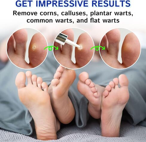 Corn Remover Liquid for Toes Feet: 20ml Salicylic Acid for Foot Corns Calluses Wart Removal at Work Home - Safe for Kids Teens Adults Seniors Athletes Runners Workers Men Women in Saudi Arabia