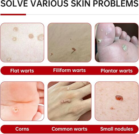 سائل مزيل الثآليل بحمض الساليسيليك بنسبة 20%، مزيل الثآليل بدون ألم للأخمصي، الشائع، الثآليل المسطحة، ذرة القدم لأجزاء متعددة من الجسم (عبوة من قطعة واحدة) in Kuwait