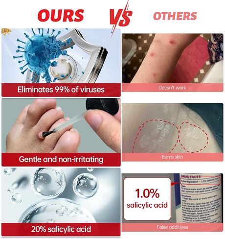 سائل مزيل الثآليل بحمض الساليسيليك بنسبة 20%، مزيل الثآليل بدون ألم للأخمصي، الشائع، الثآليل المسطحة، ذرة القدم لأجزاء متعددة من الجسم (عبوة من قطعة واحدة) in Kuwait