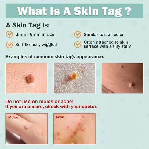 Skin Clinic Freeze Point for Warts and Skin Tags, 1 Warts and SkinTag Removal Kit About 10 Treatments, Safe Home Use Cryogenic Freeze-Off Kit, Wart and SkinTags Removal in 7-14 Days 01271740 in Kuwait