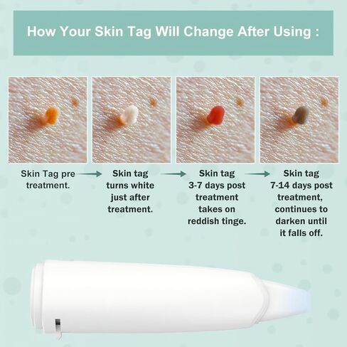 Skin Clinic Freeze Point for Warts and Skin Tags, 1 Warts and SkinTag Removal Kit About 10 Treatments, Safe Home Use Cryogenic Freeze-Off Kit, Wart and SkinTags Removal in 7-14 Days 01271740 in Kuwait
