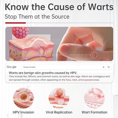 مزيل الثآليل، سائل مزيل الثآليل بحمض الساليسيليك بنسبة 25%، مزيل الثآليل العلاجي سريع المفعول للثآليل الأخمصية للقدمين، حمض الساليسيليك للثآليل، مزيل الذرة لأصابع القدم، الثآليل الشائعة والمسطحة، 1.18 أونصة سائلة in Kuwait