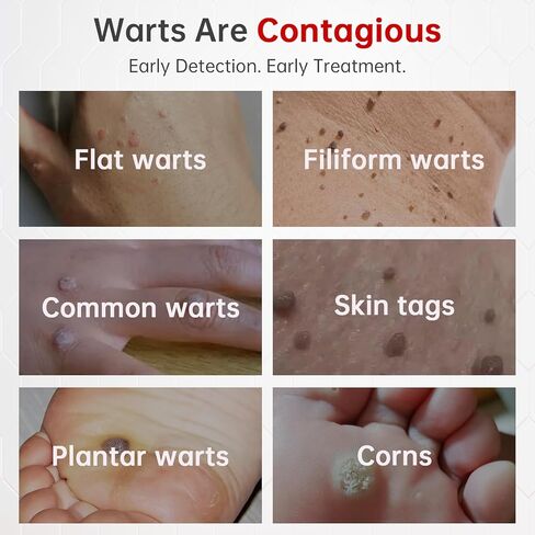 مزيل الثآليل، سائل مزيل الثآليل بحمض الساليسيليك بنسبة 25%، مزيل الثآليل العلاجي سريع المفعول للثآليل الأخمصية للقدمين، حمض الساليسيليك للثآليل، مزيل الذرة لأصابع القدم، الثآليل الشائعة والمسطحة، 1.18 أونصة سائلة in Kuwait