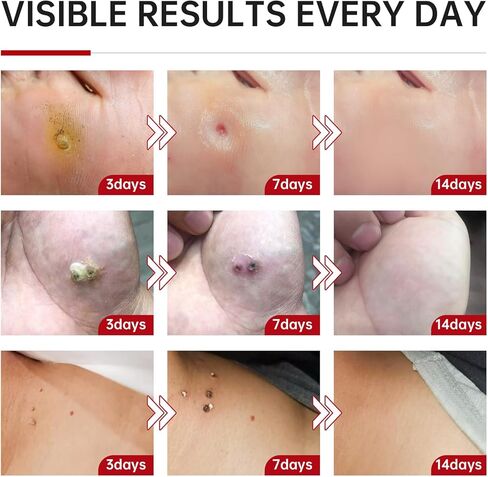 مزيل الثآليل، سائل مزيل الثآليل بحمض الساليسيليك بنسبة 25%، مزيل الثآليل العلاجي سريع المفعول للثآليل الأخمصية للقدمين، حمض الساليسيليك للثآليل، مزيل الذرة لأصابع القدم، الثآليل الشائعة والمسطحة، 1.18 أونصة سائلة in Kuwait