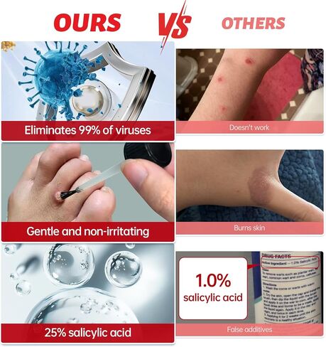 مزيل الثآليل، سائل مزيل الثآليل بحمض الساليسيليك بنسبة 25%، مزيل الثآليل العلاجي سريع المفعول للثآليل الأخمصية للقدمين، حمض الساليسيليك للثآليل، مزيل الذرة لأصابع القدم، الثآليل الشائعة والمسطحة، 1.18 أونصة سائلة in Kuwait